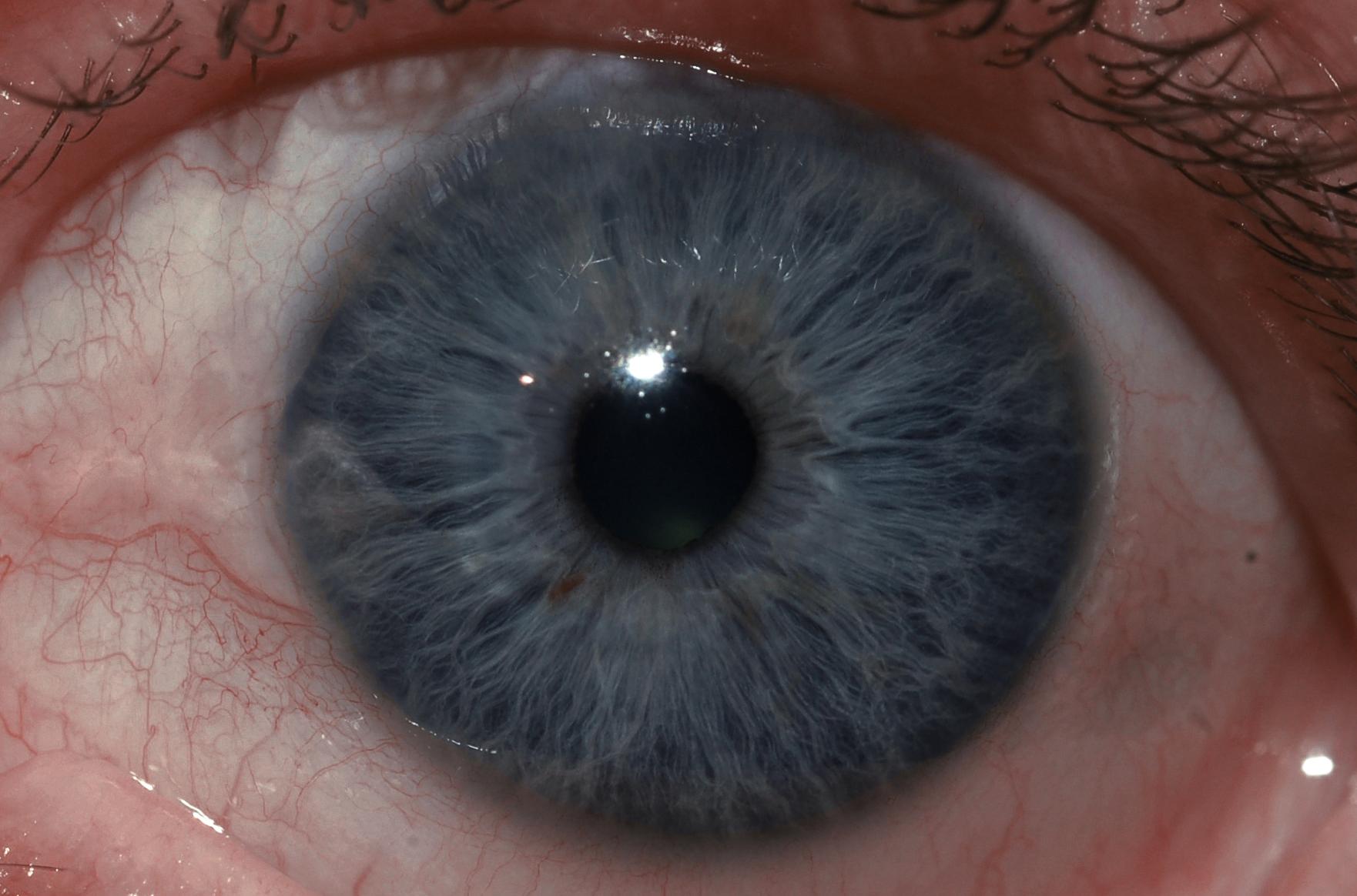 Aajonus's iris in May of 2007