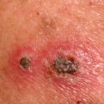 Injection site after 72 hours