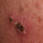 Injection site after 72 hours